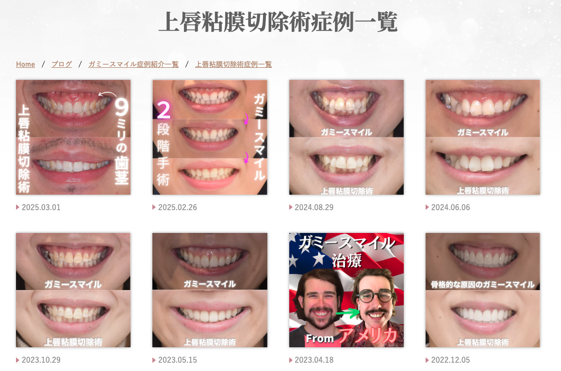 上唇粘膜切除術症例一覧