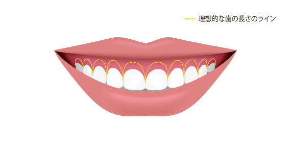 歯冠長延長術とは？歯茎の量が多い/歯が短い人に適応