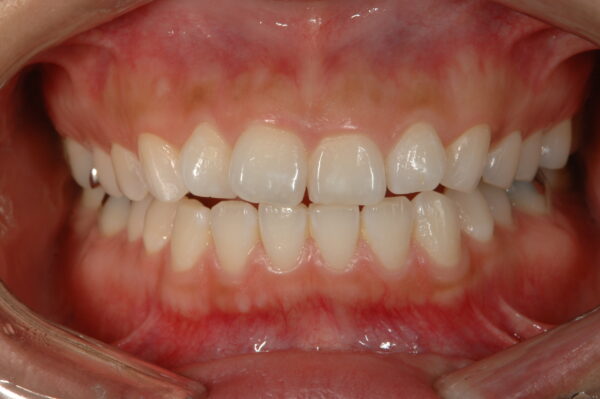 ②歯肉の過剰な発育障害➡︎歯肉を切除（臨床的歯冠長延長術）