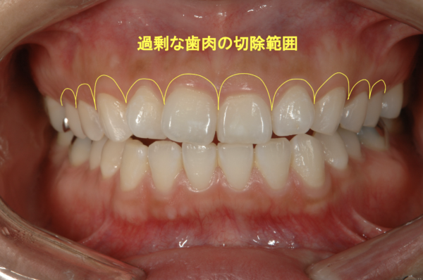 ②歯肉の過剰な発育障害➡︎歯肉を切除（臨床的歯冠長延長術）