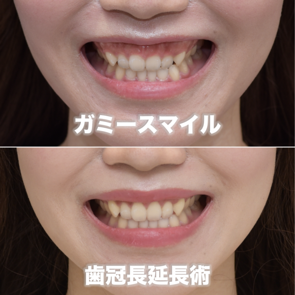 正常よりも歯が３mmほど短いガミースマイルを治療した症例（歯冠長延長術）