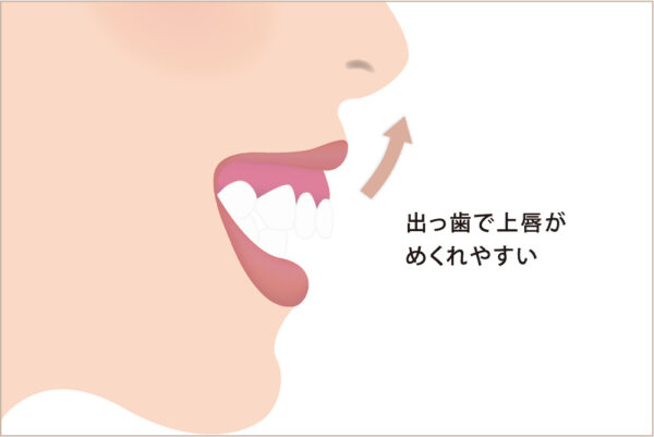 原因②：歯性の上顎前突（出っ歯）