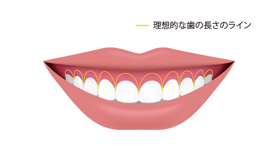 ①歯の長さが原因