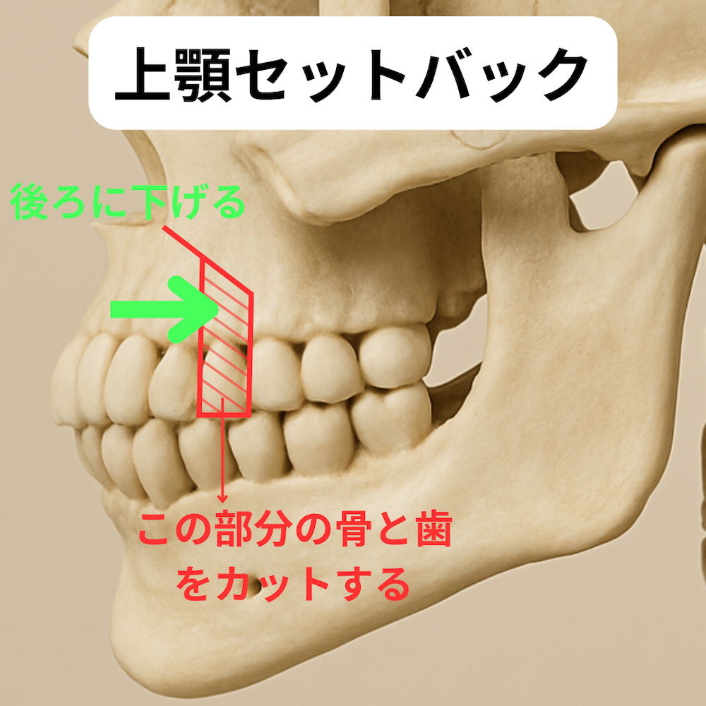 セットバック整形とは