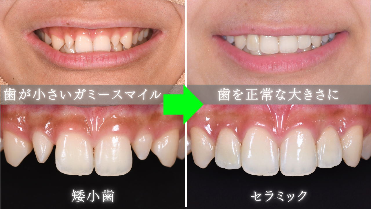 image_tooltip セラミック・ラミネートベニアで歯を大きくする