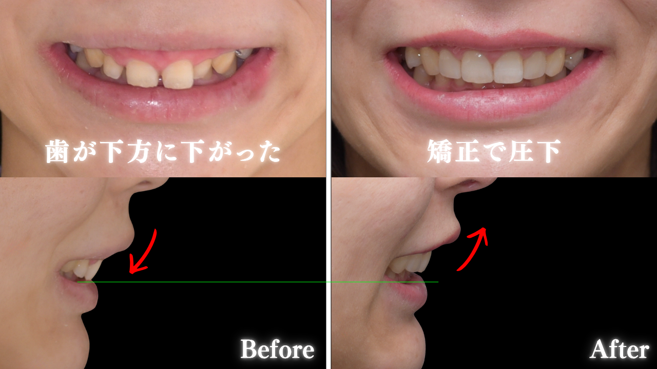 image_tooltip 「圧下」という矯正治療で改善