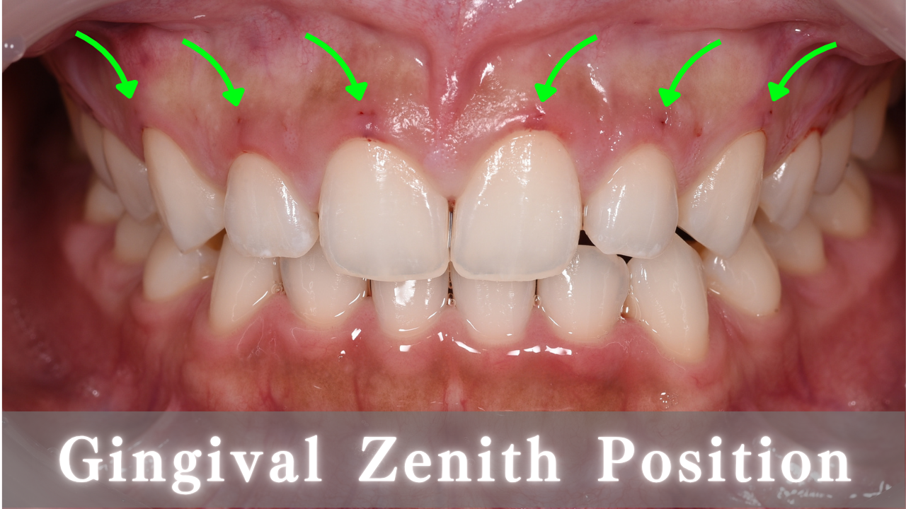 image_tooltip Gingival Zenith Position