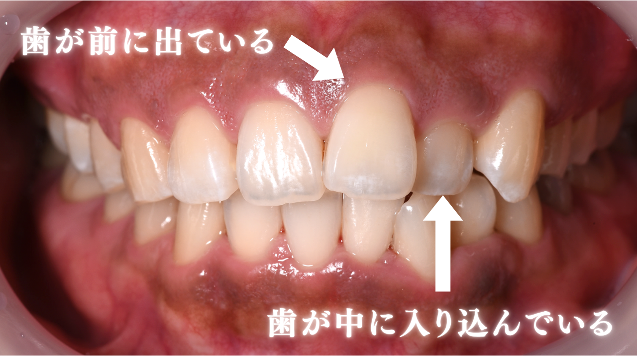 image_tooltip 飛び出した歯に合わせて、歯茎の高さを揃える