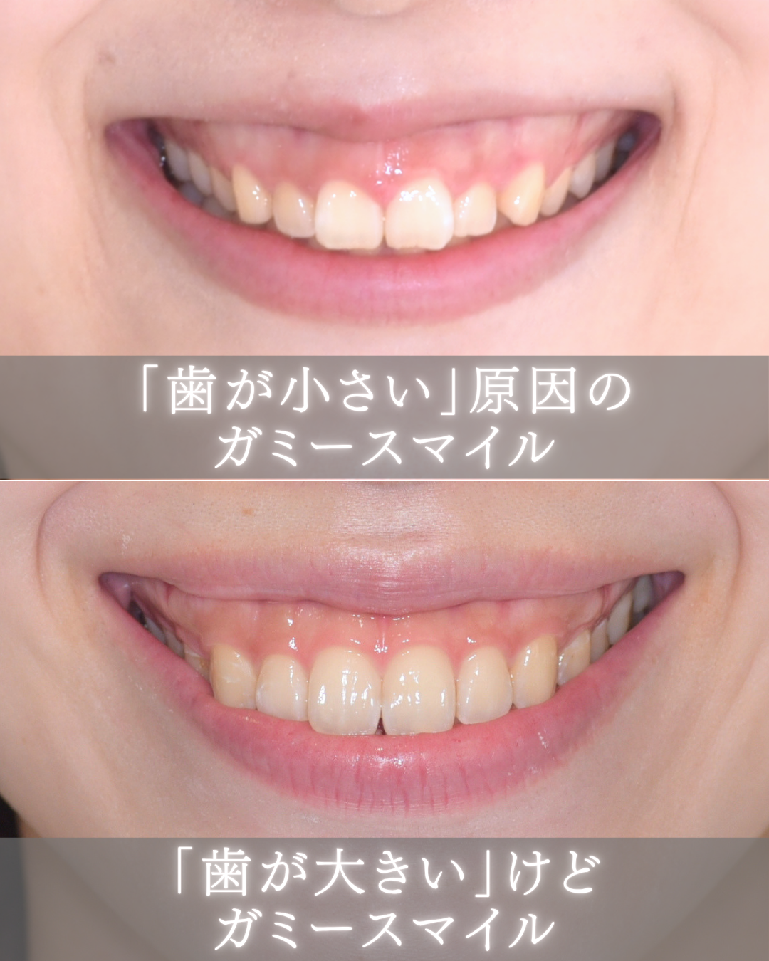 image_tooltip 歯が小さい/大きい 原因のガミースマイル