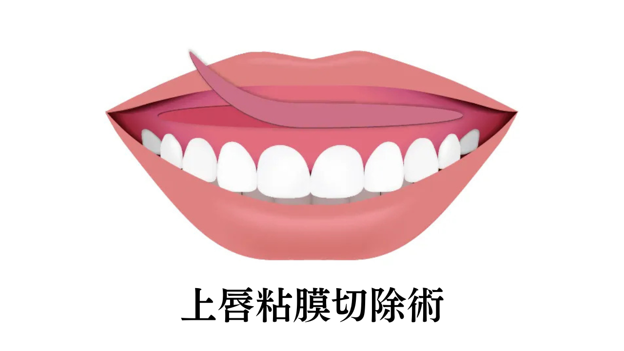image_tooltip 上唇粘膜切除術
