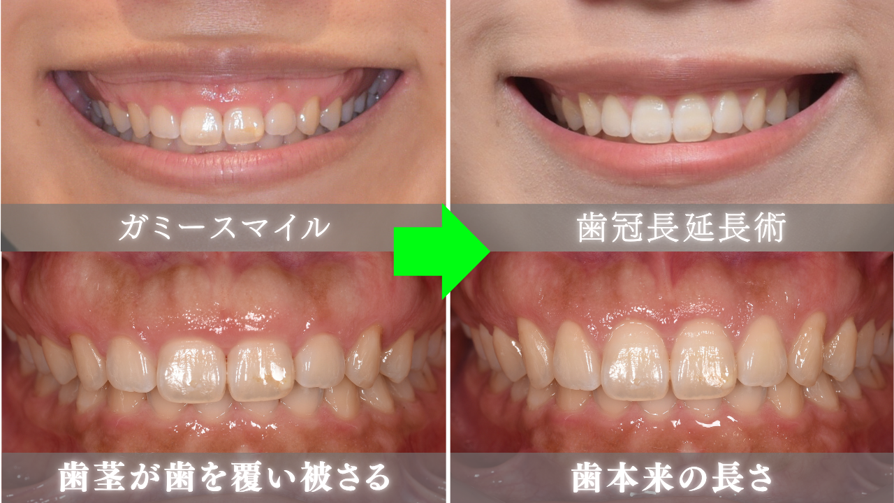 image_tooltip 歯茎が歯を覆い被さる状態を歯冠長延長術で歯本来の長さに