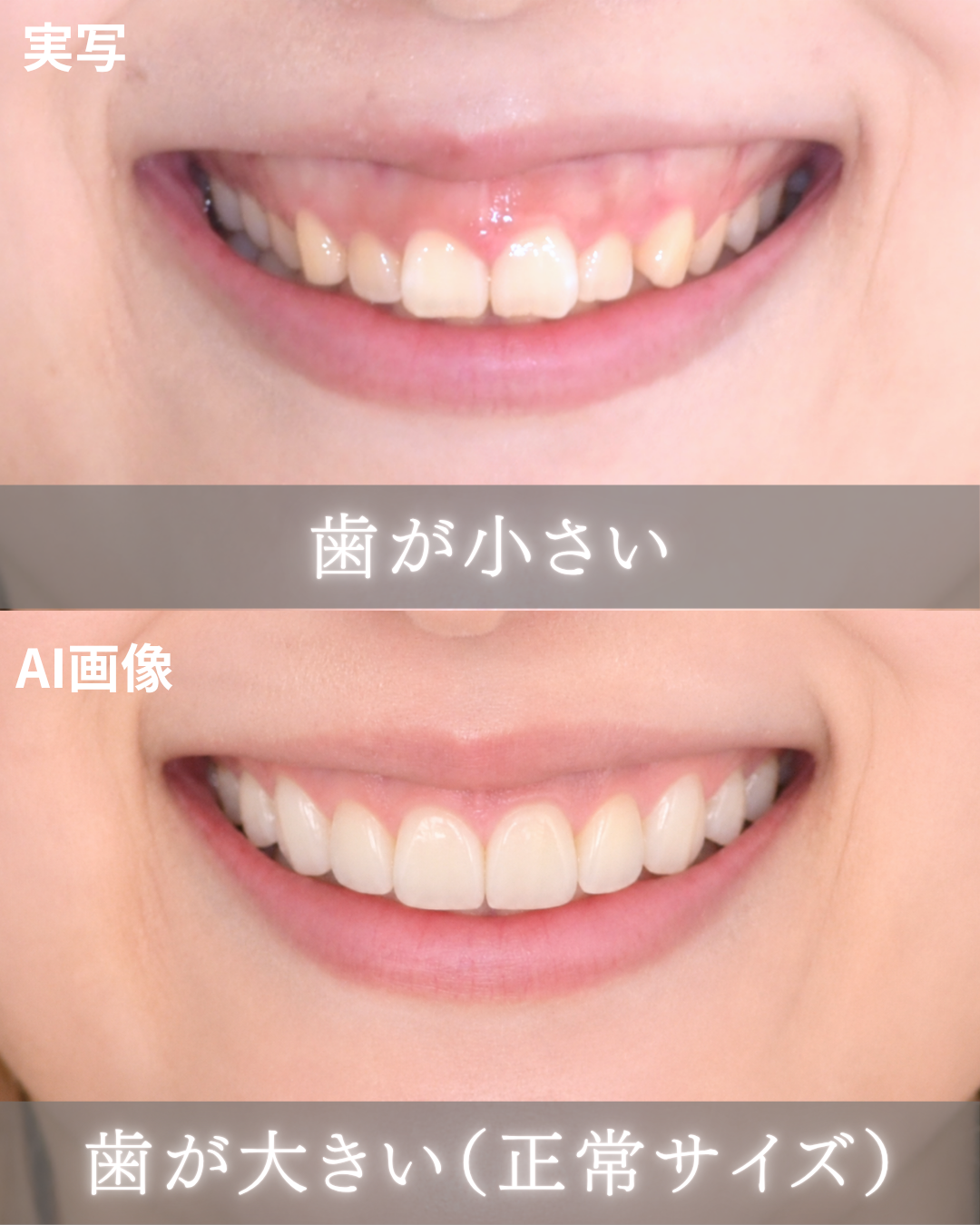 image_tooltip ガミースマイル