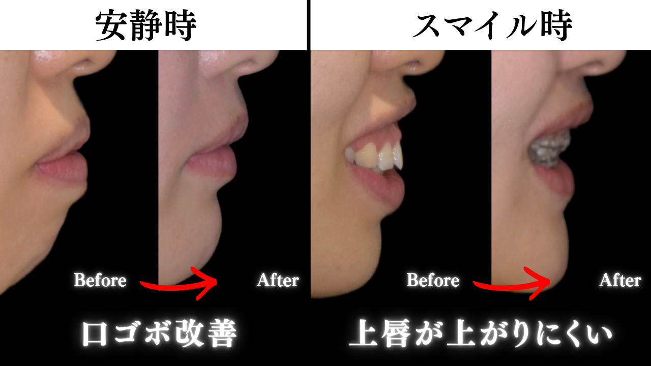 image_tooltip 矯正治療(圧下など)で歯や歯茎の位置を整える