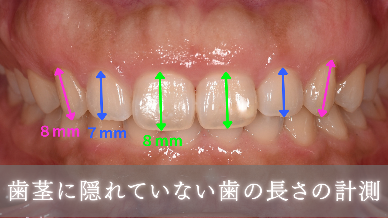 image_tooltip 歯茎に隠れていない歯の長さの計測