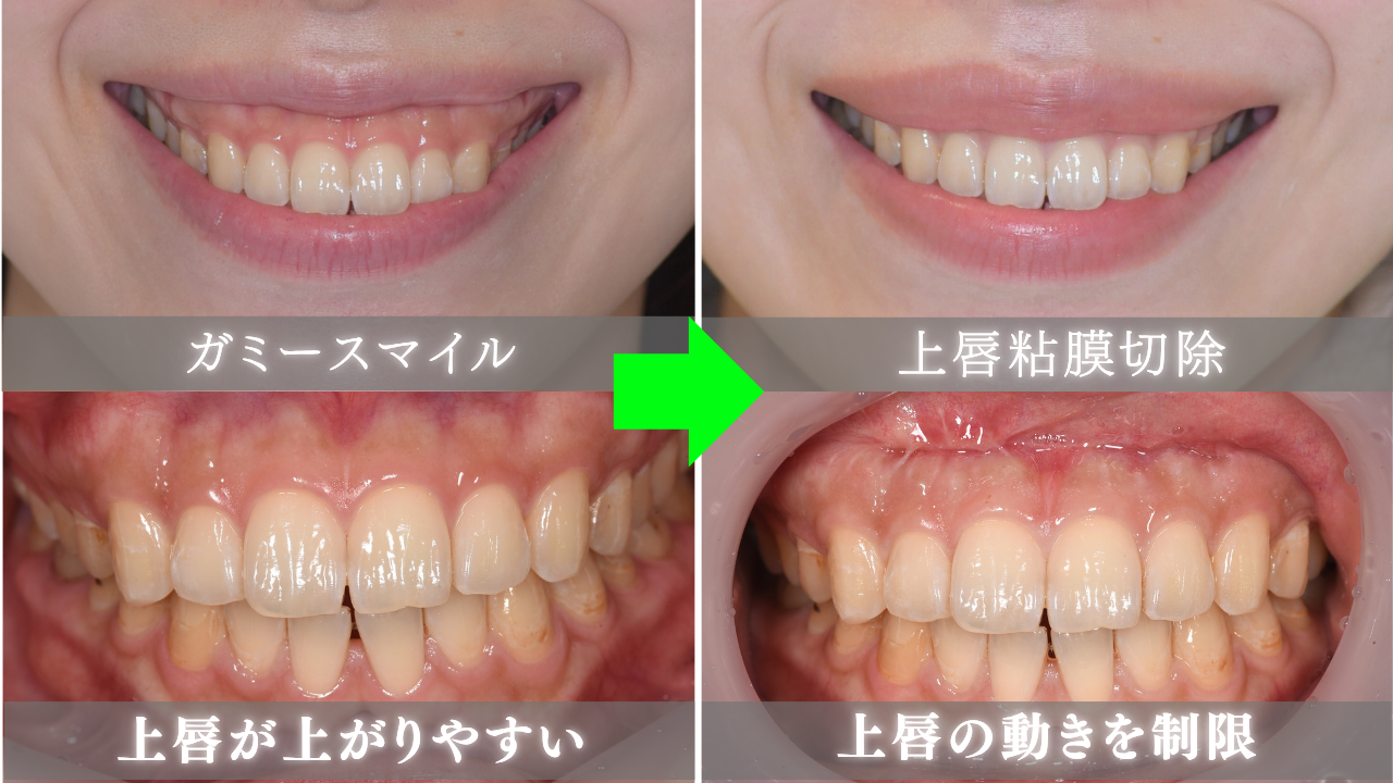 image_tooltip 上唇粘膜切除術で改善
