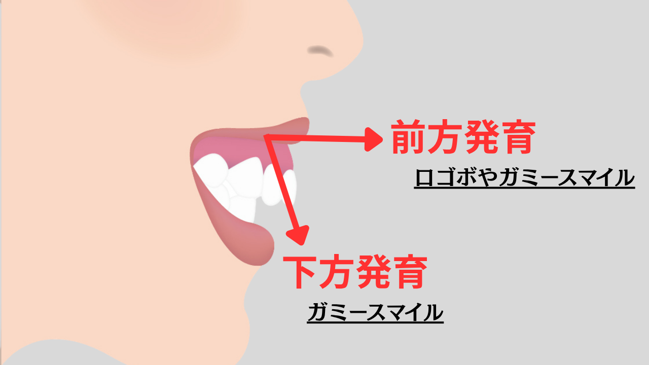 image_tooltip 上顎骨の過成長・上顎前突(骨格が原因のケース)