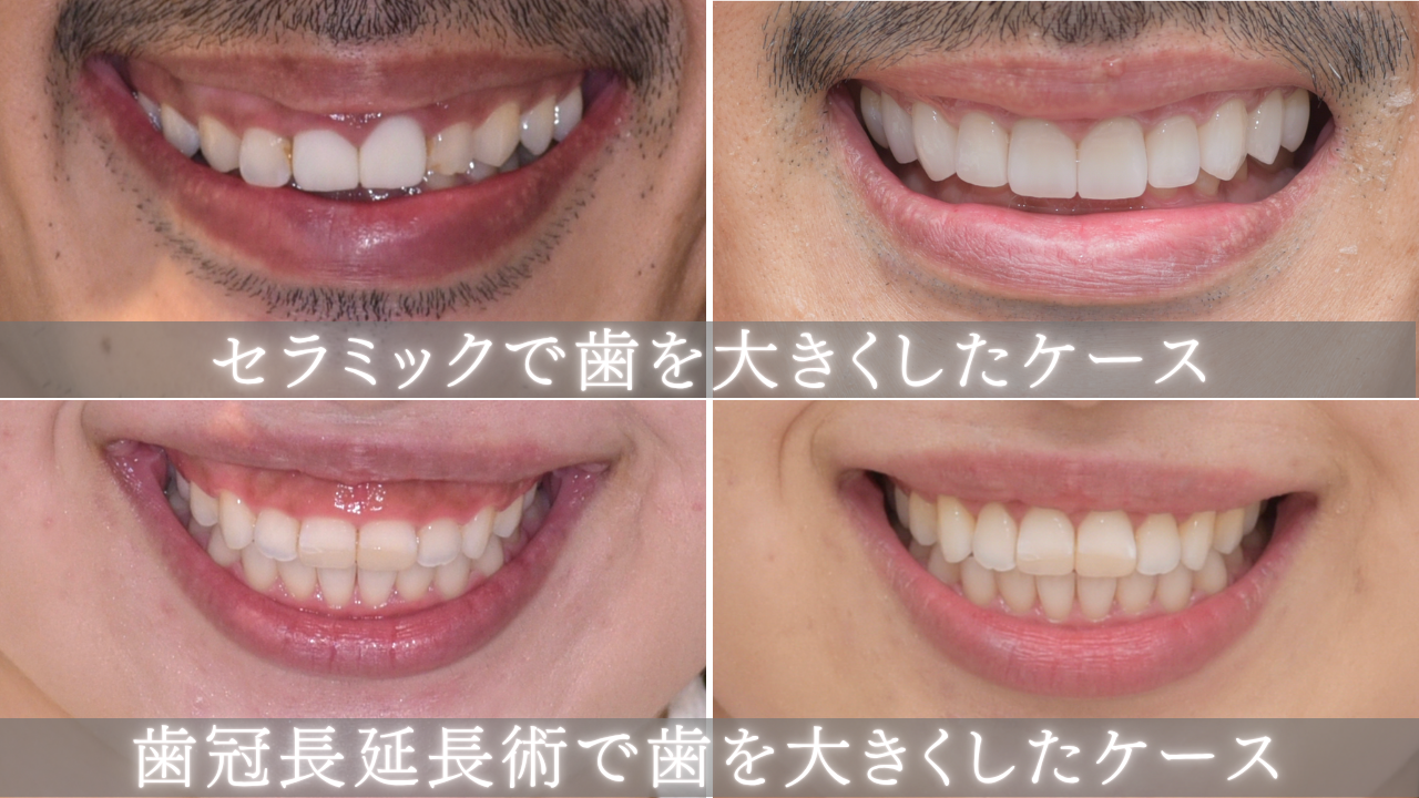 image_tooltip セラミック・歯冠長延長術で歯を大きくしたケース