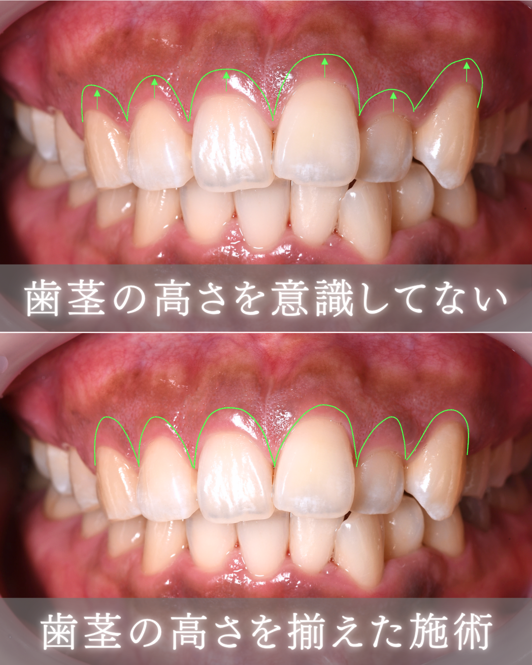 image_tooltip 歯茎の高さをそろえた施術