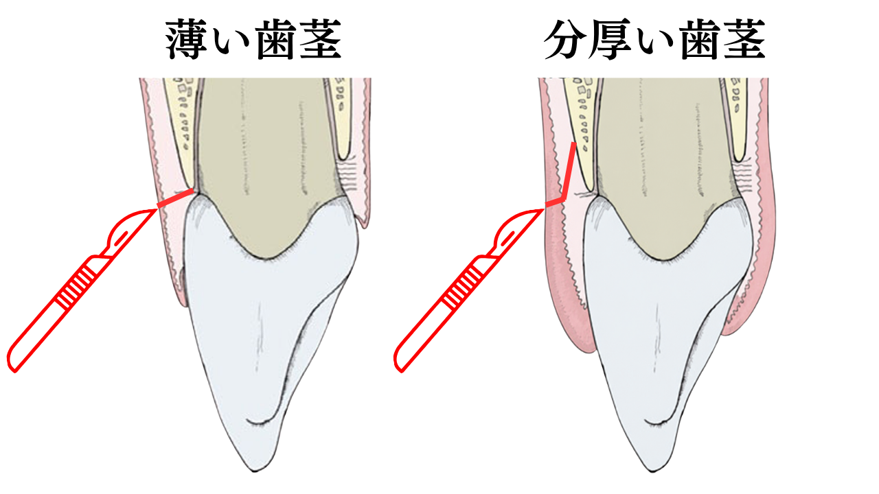 image_tooltip 歯茎が分厚い方の歯冠長延長術を行う際は、当院では歯茎の厚みを薄くするような切開を行う