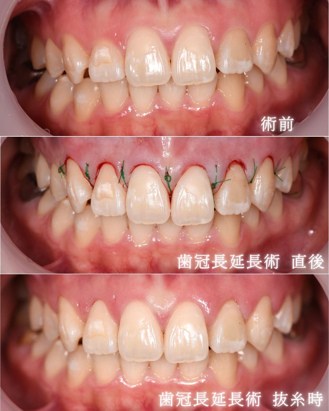 image_tooltip 歯冠長延長術