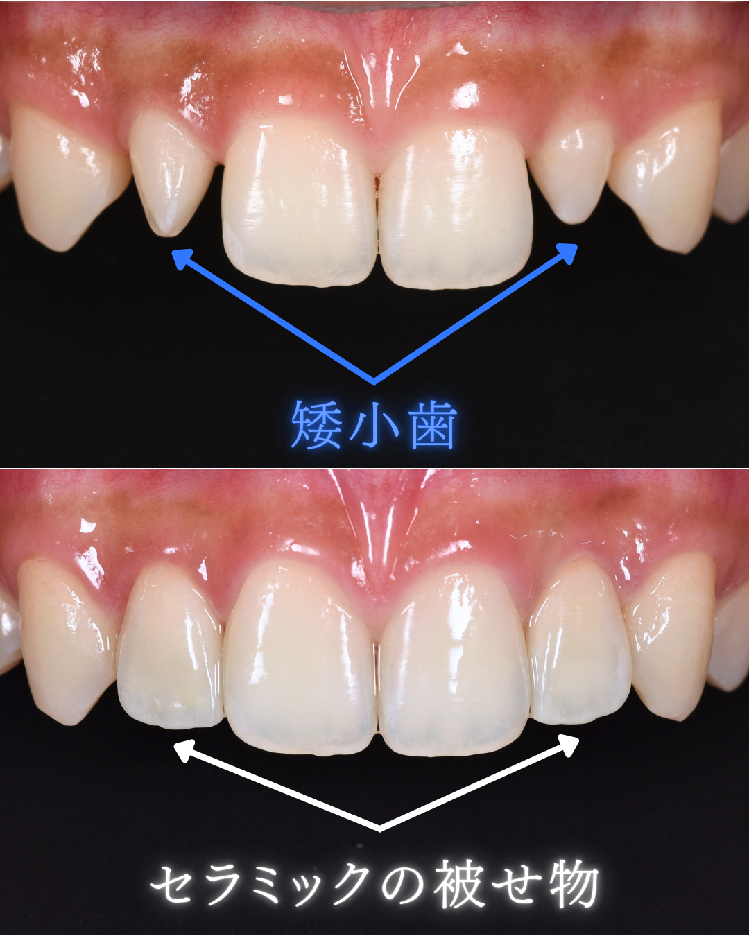 image_tooltip 矮小歯