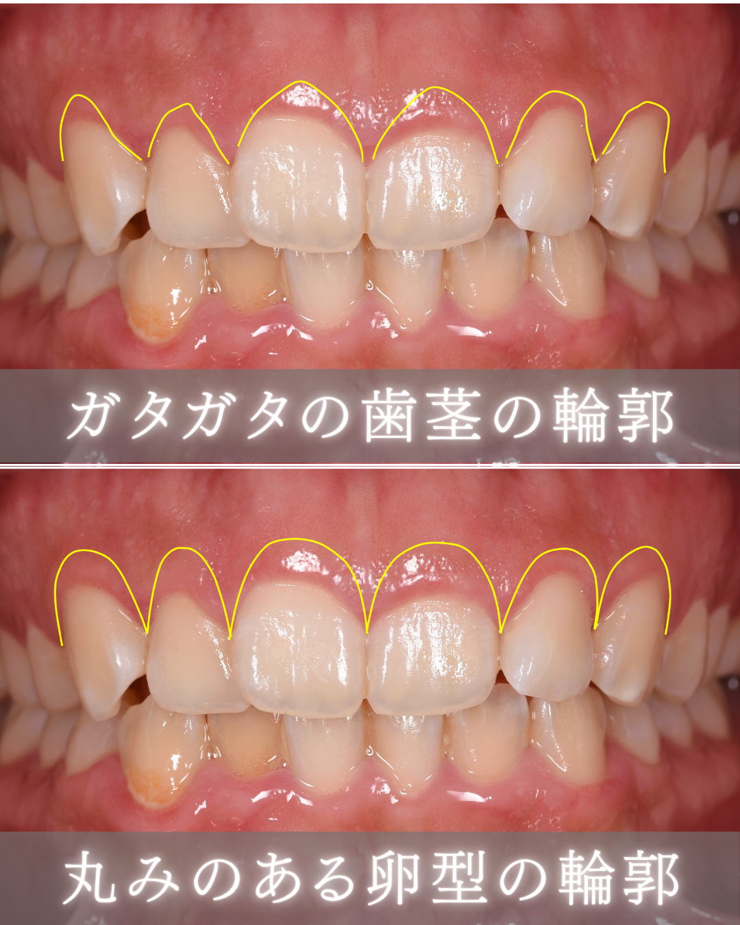 image_tooltip 歯の形に合わせて、切開の形を変えている