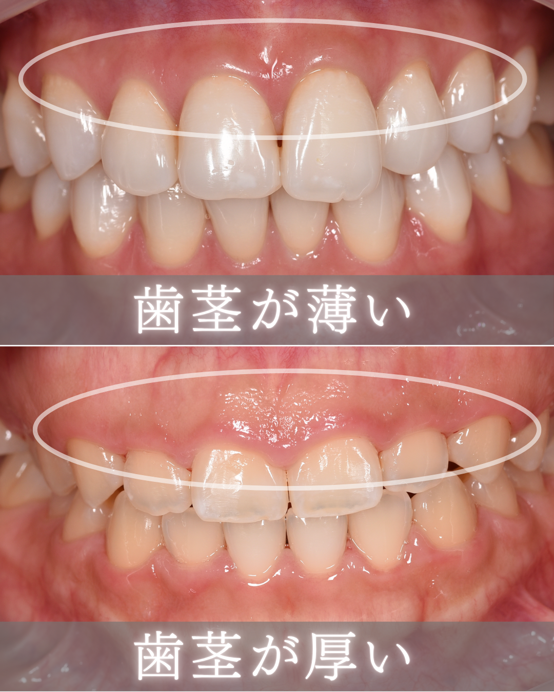 image_tooltip 歯茎の厚みによって、メスの角度を変える