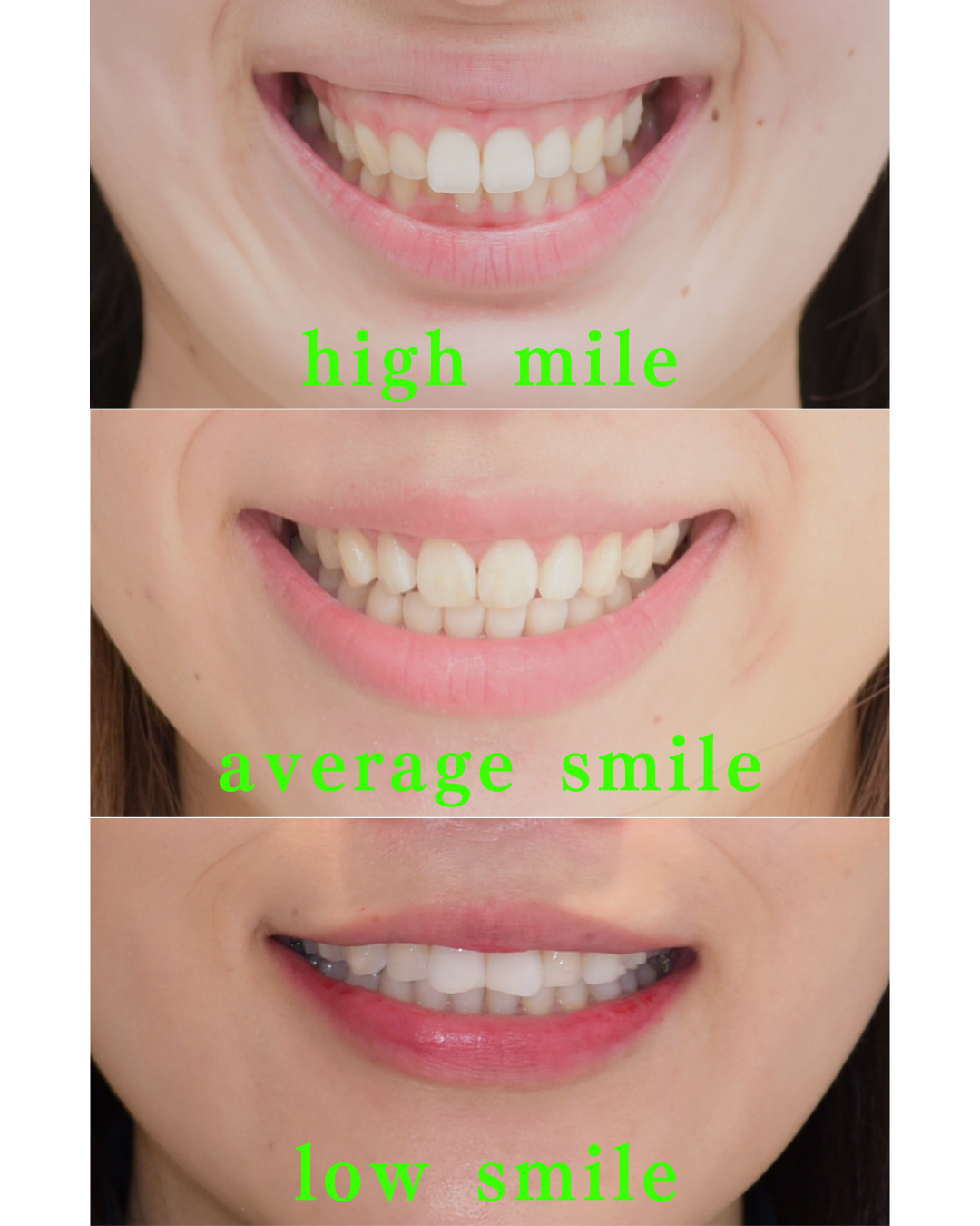 image_tooltip ガミースマイルの種類