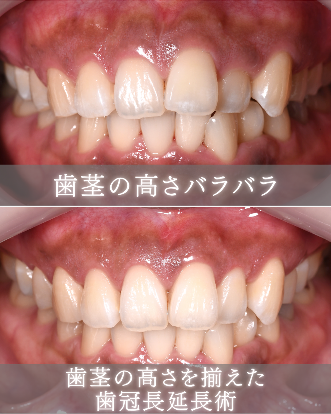image_tooltip 歯茎の高さをそろえた歯冠長延長術