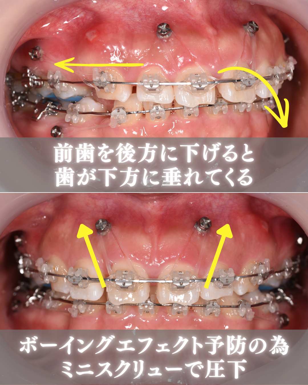 image_tooltip 矯正で前歯を下げたあとにガミースマイルが目立つこともある