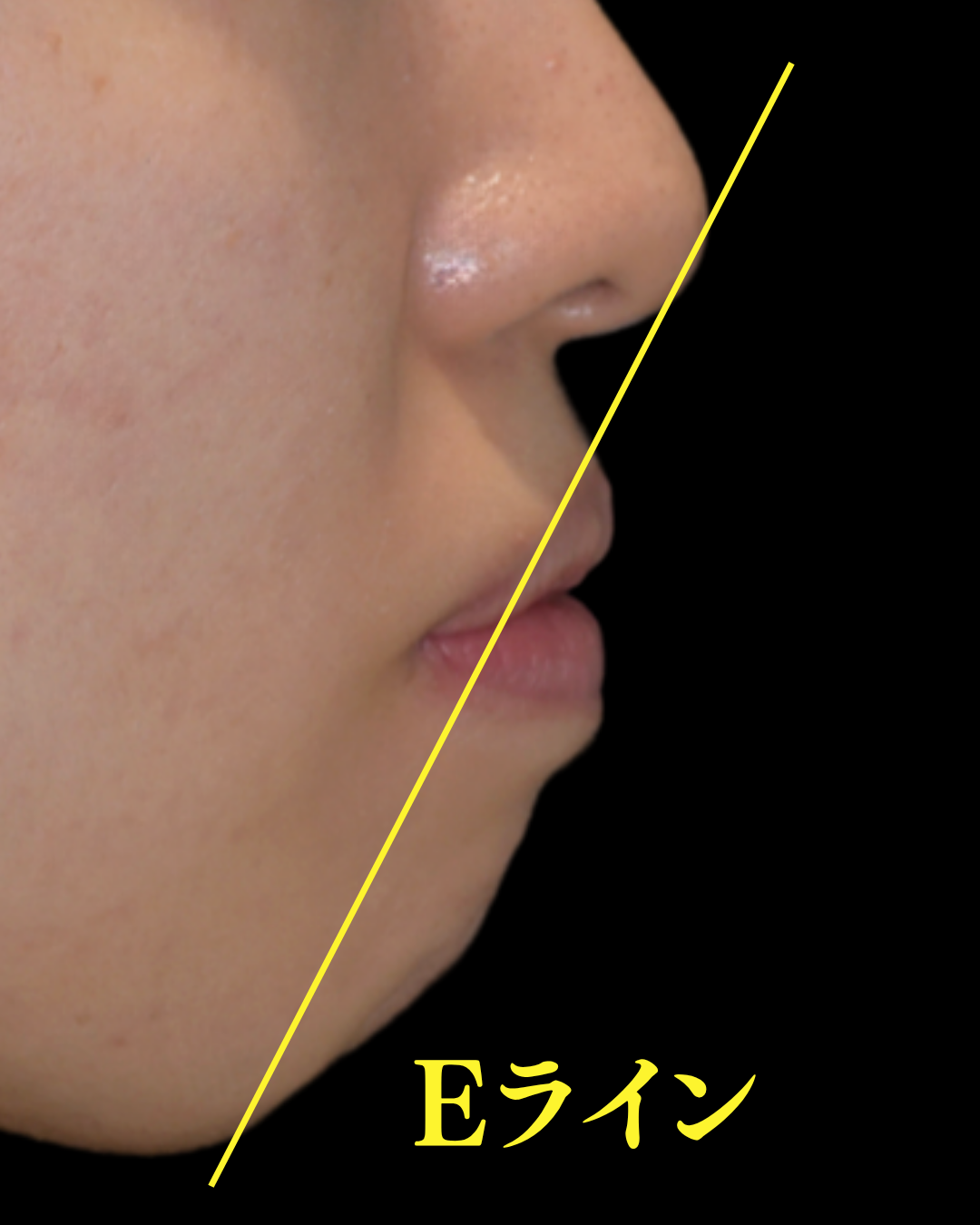 image_tooltip Eラインで確認できる横顔の口元の出っ張り