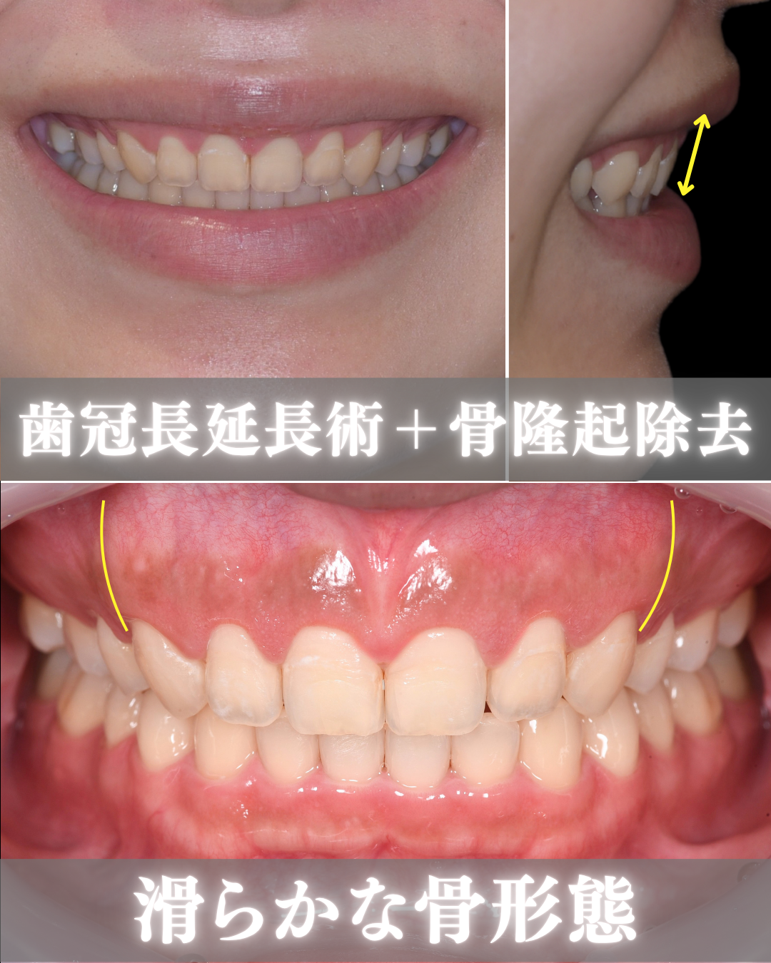 image_tooltip 骨隆起切除