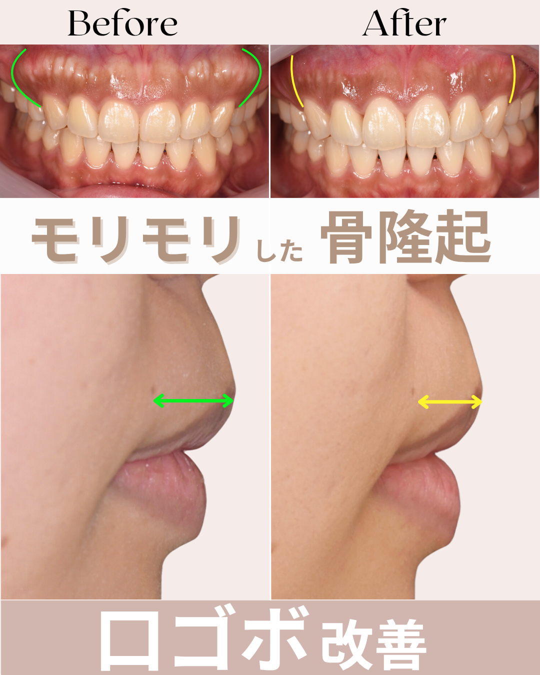 image_tooltip 骨隆起切除の症例