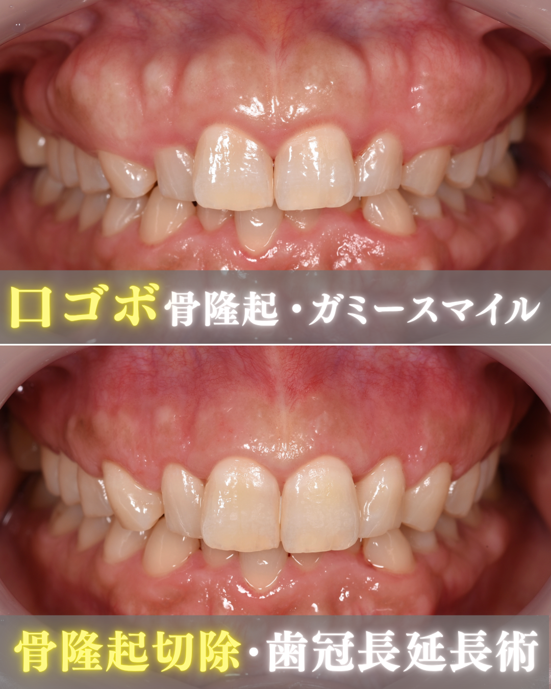 image_tooltip 口元に引っかかるような違和感があり、自然に笑えない