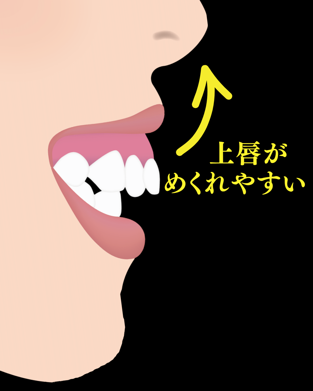 image_tooltip 唇は前方へ張り出した歯や歯茎の上に乗り上げるような状態