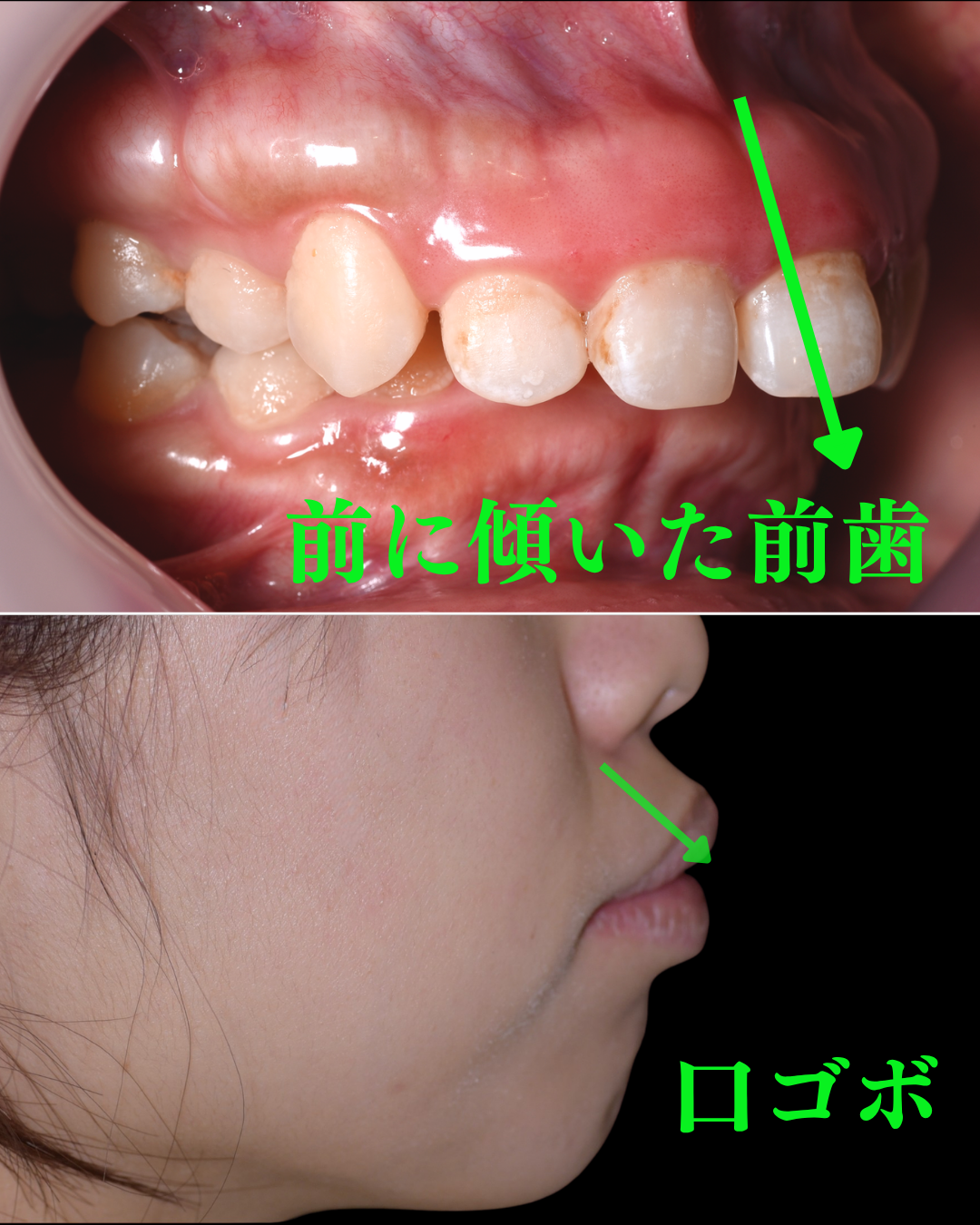 image_tooltip 前歯が前に傾いている|歯の位置による口ゴボ