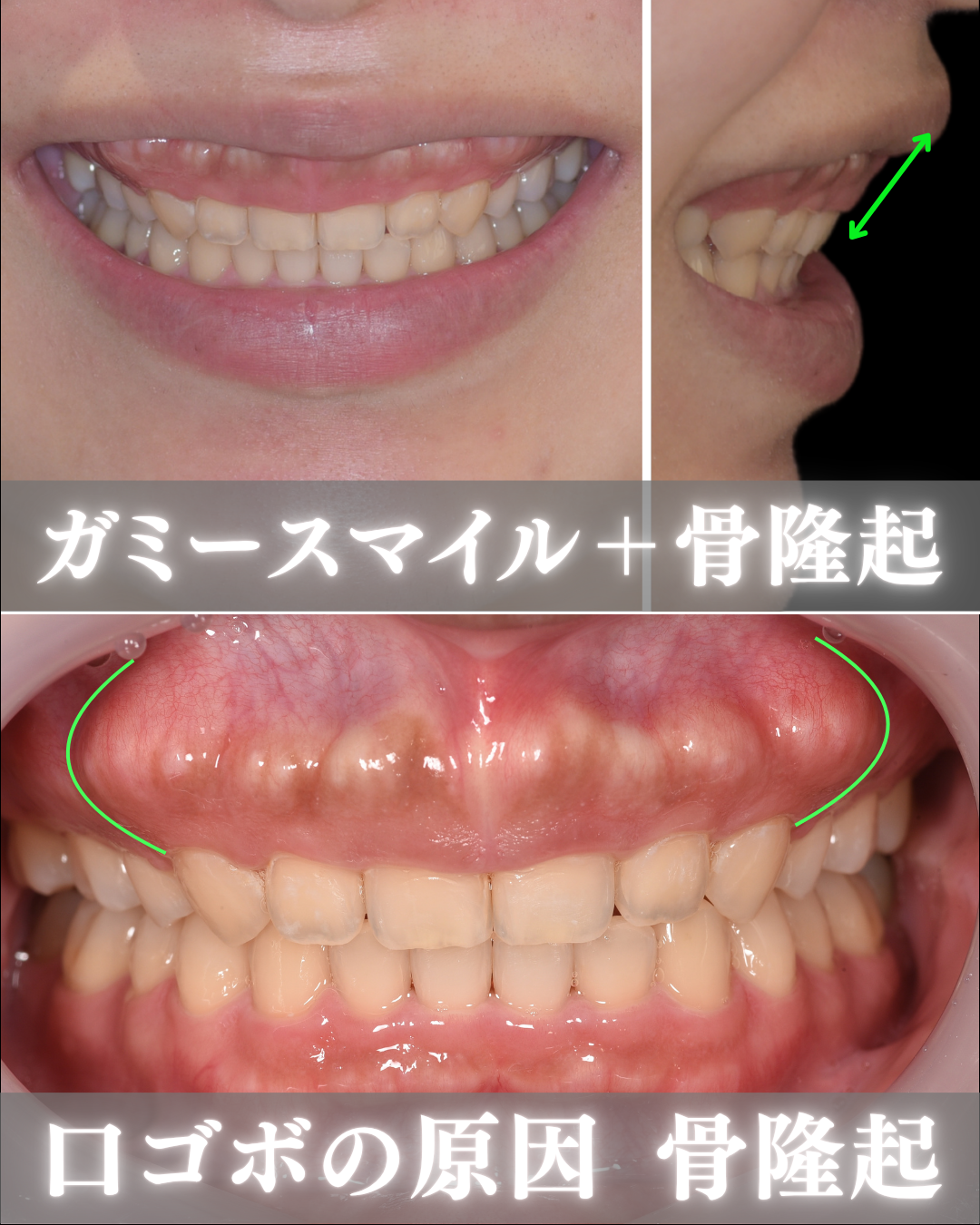 image_tooltip 骨隆起