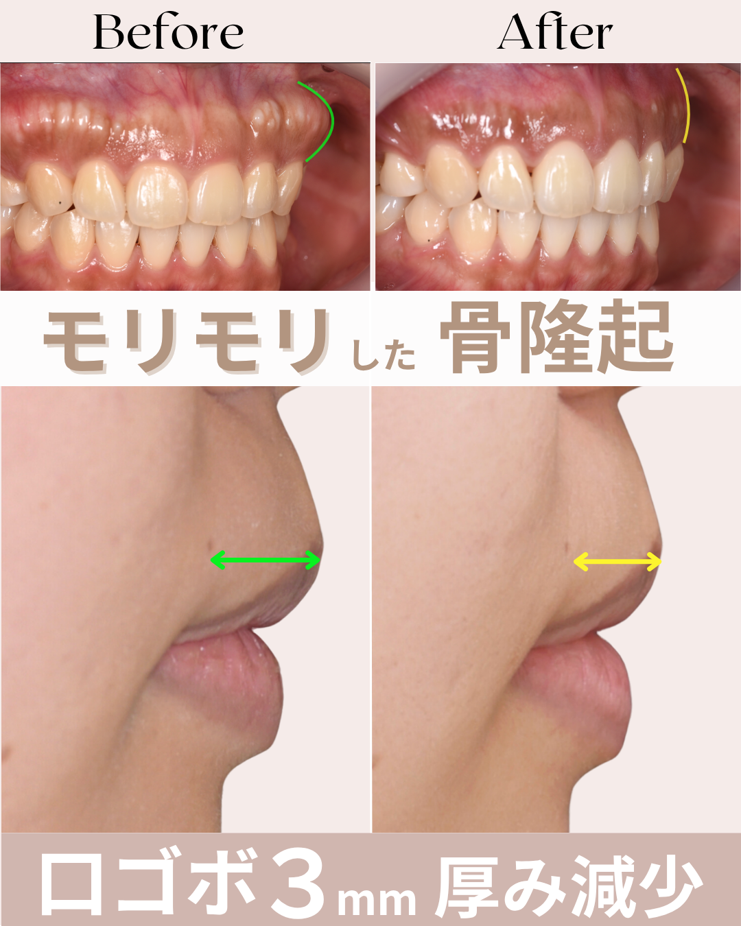 image_tooltip 口元は術前より約3mm後方へ