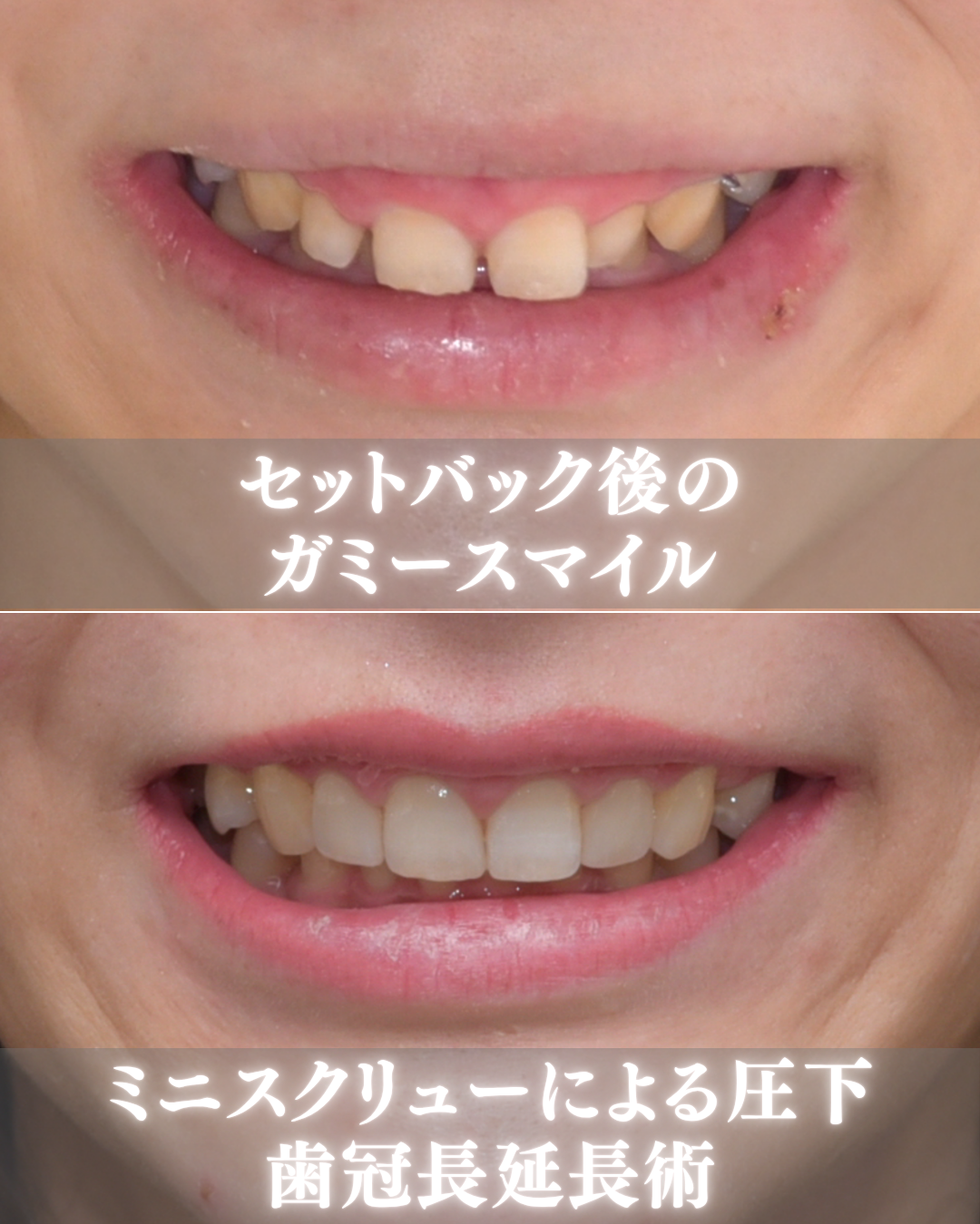 image_tooltip セットバック手術後
