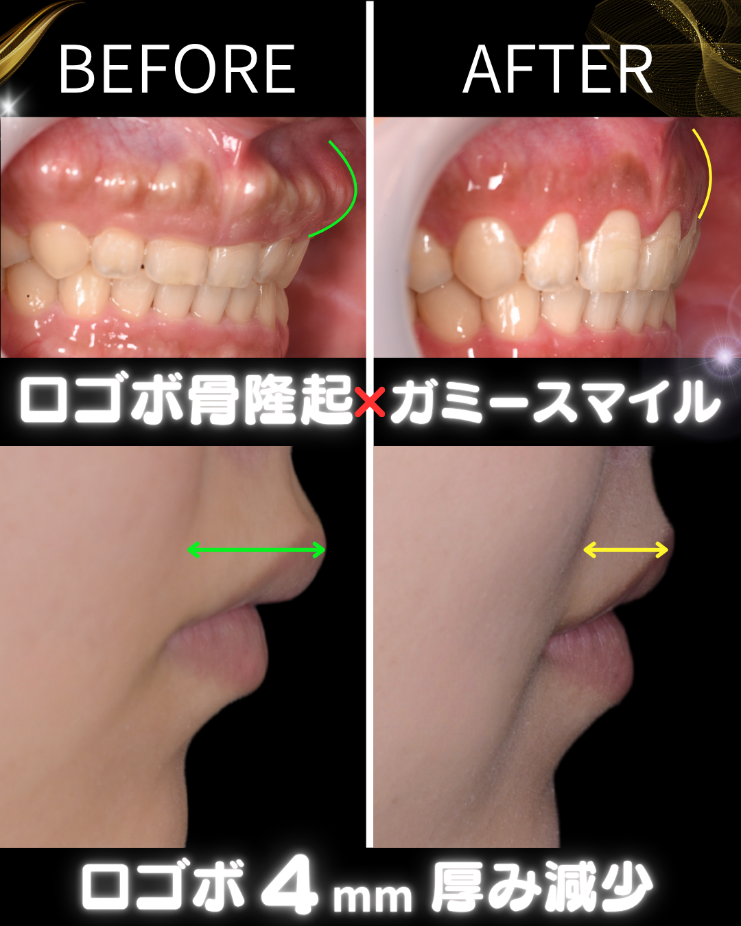 image_tooltip 口元の厚みは治療前より約4mm減少
