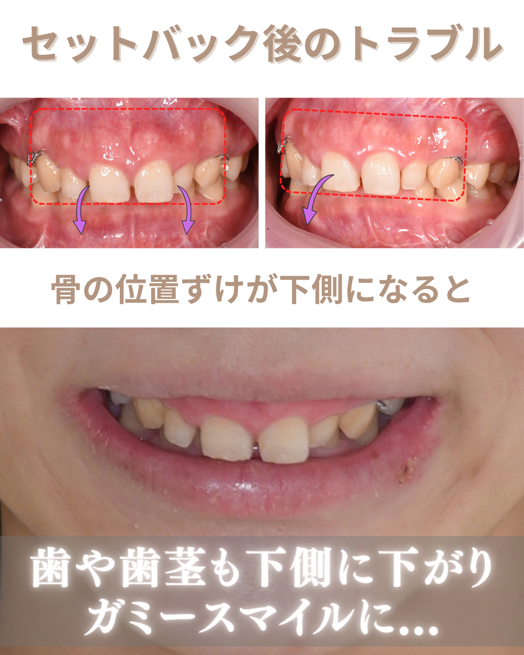 image_tooltip セットバック手術後のトラブル