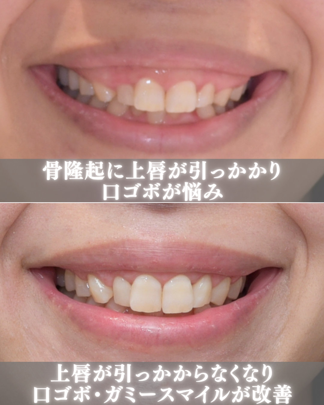 image_tooltip 骨隆起切除によって前方へ張り出した骨を整えると、上唇が歯茎の表面を滑らかに動けるようになります。