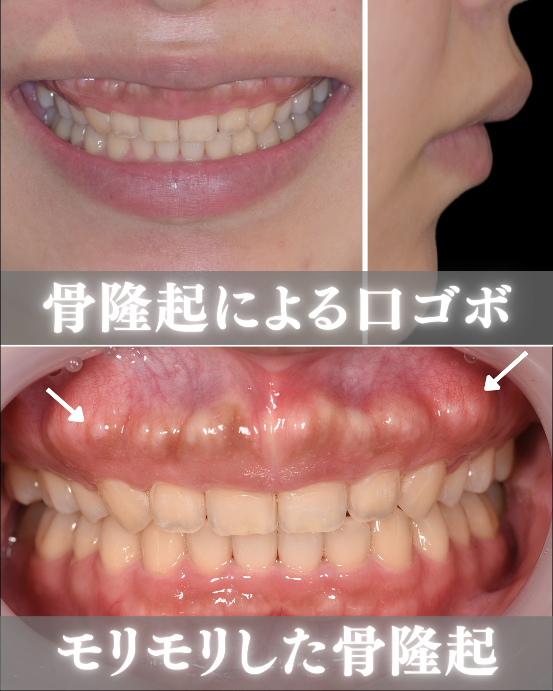 image_tooltip 歯茎の中の骨が膨らんでいる|骨隆起による口ゴボ