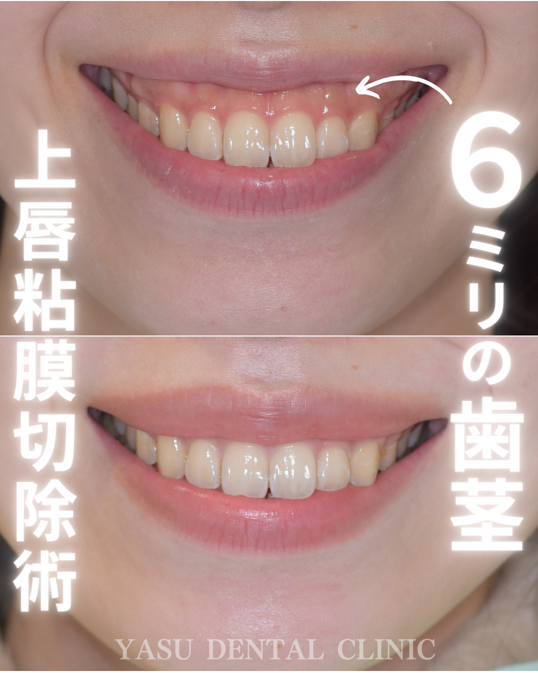 image_tooltip 歯茎が6mm見えるような重度のガミースマイルでも、大きな改善が得られる