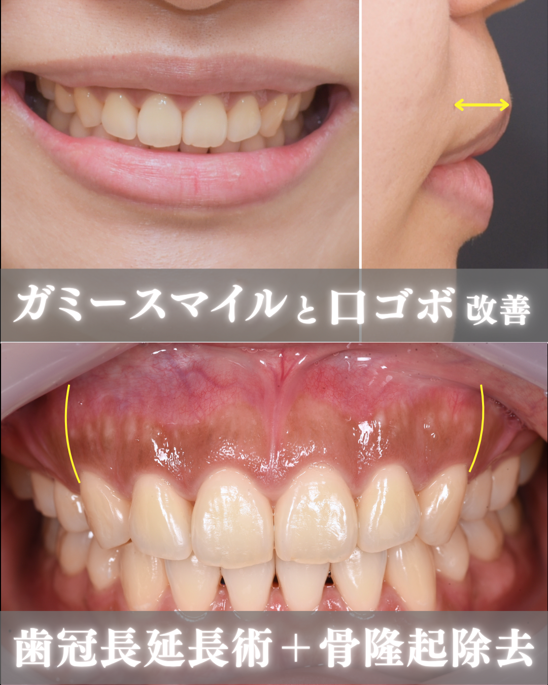 image_tooltip ガミースマイルと口ゴボ改善