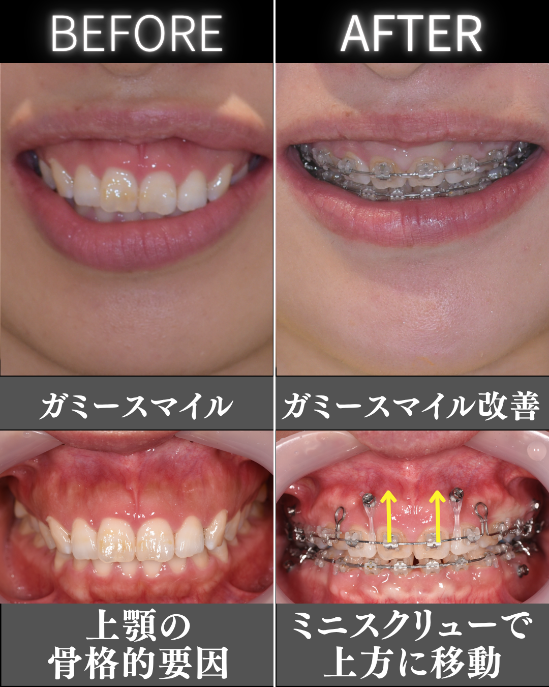 image_tooltip 矯正治療と組み合わせて口元を整えている治療経過症例