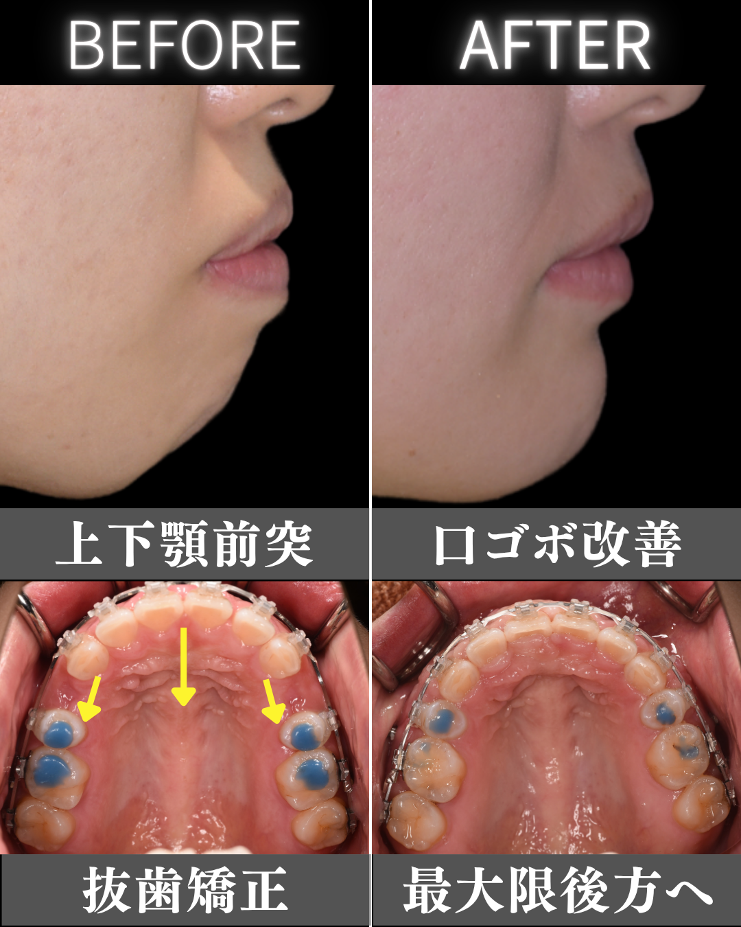 image_tooltip 矯正治療と組み合わせて口元を整えている治療経過症例
