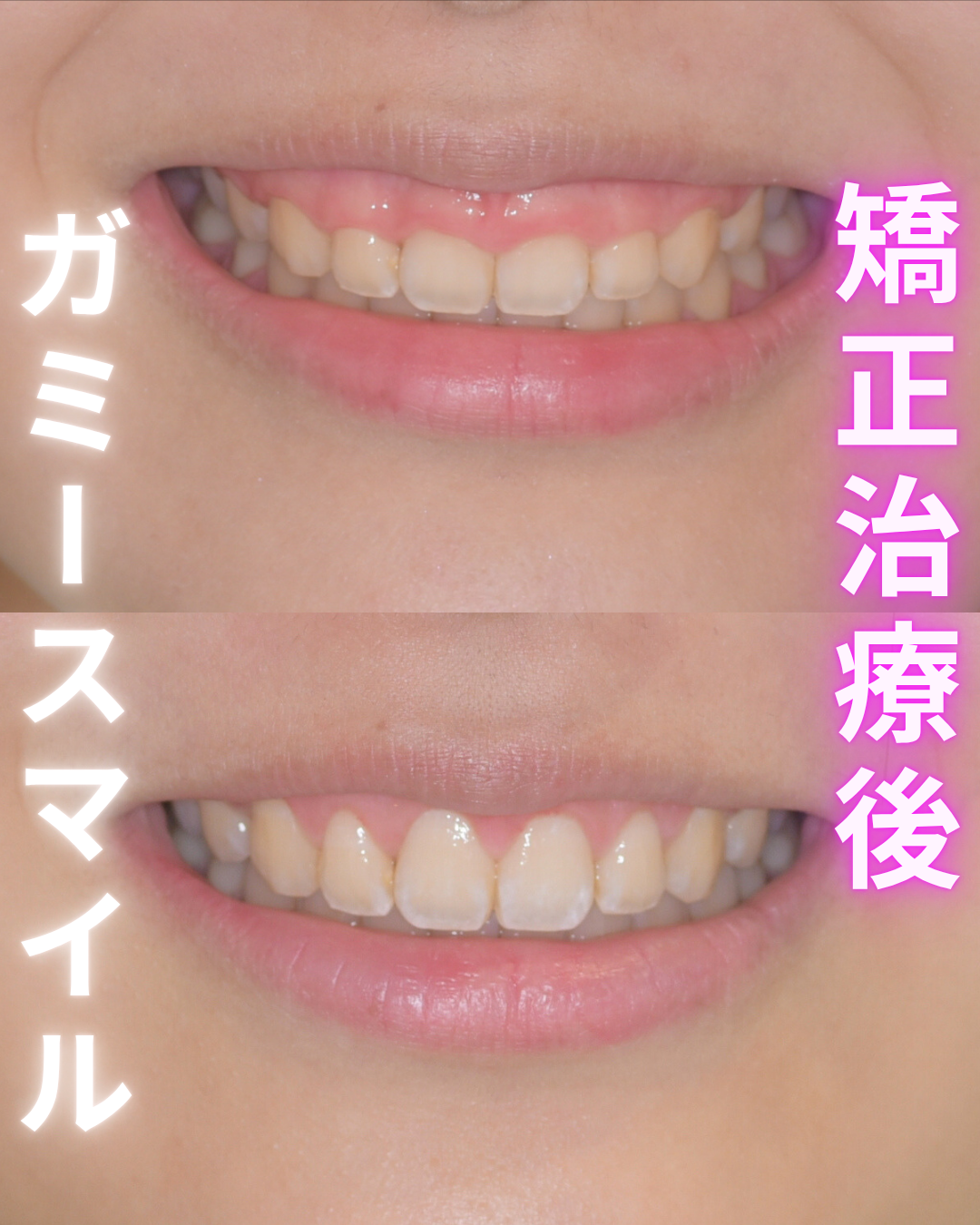 image_tooltip 矯正治療後ガミースマイル
