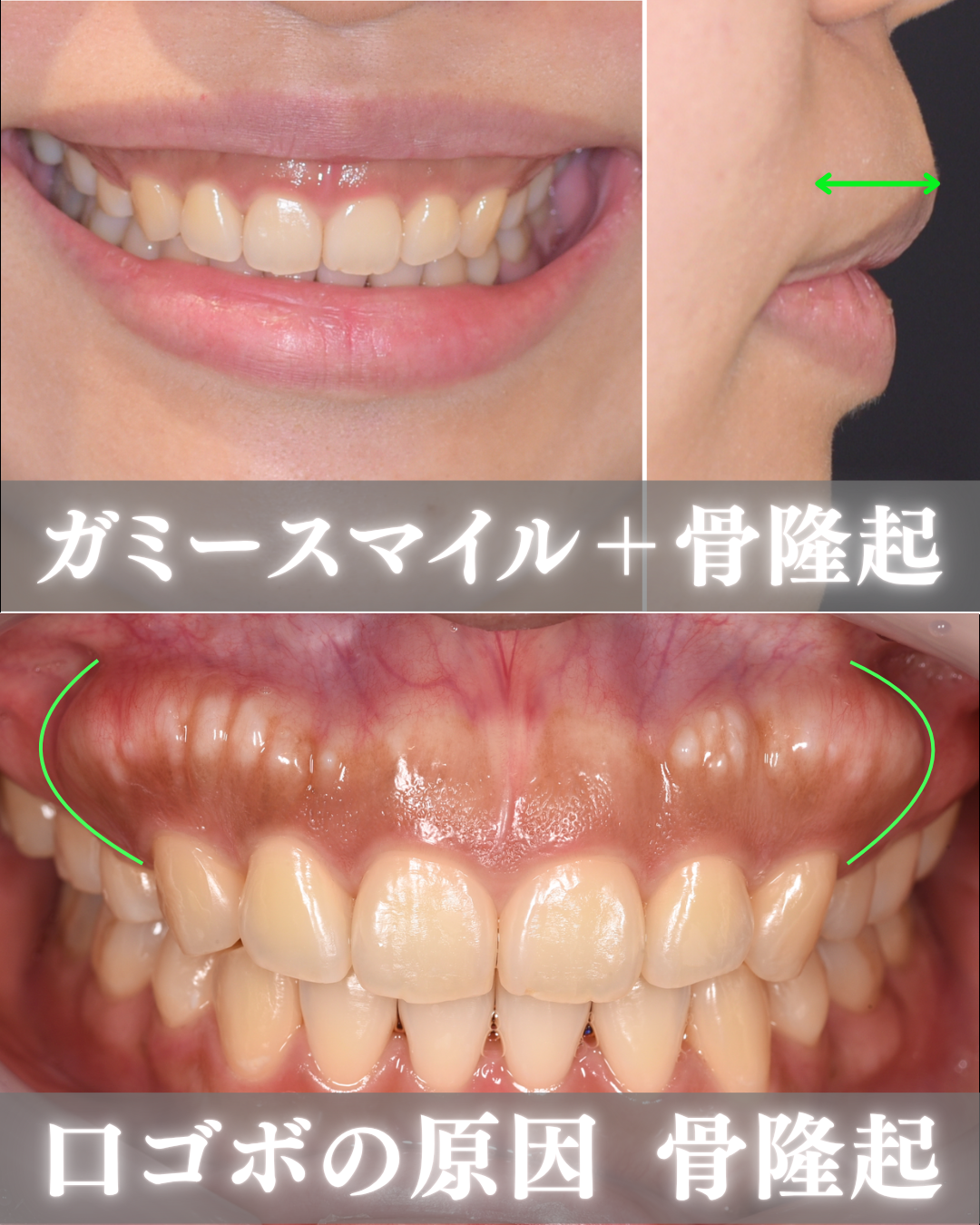 image_tooltip 歯茎が3〜4mmほど見えるガミースマイル