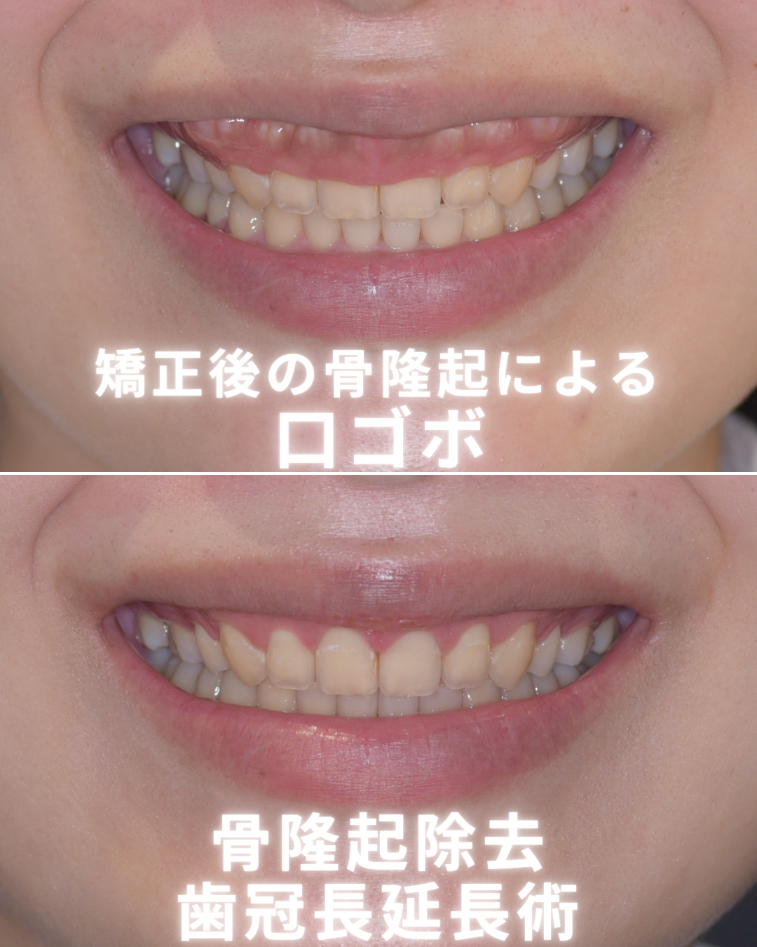 image_tooltip ガミースマイルと口元の印象が改善